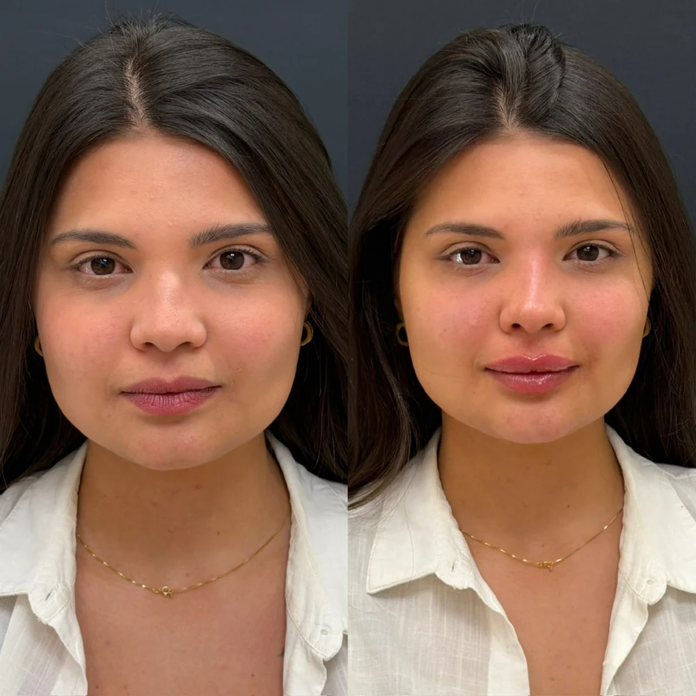 Caso Clínico Harmonização Full Face Feminina - Antes e Depois na Clinic Allure