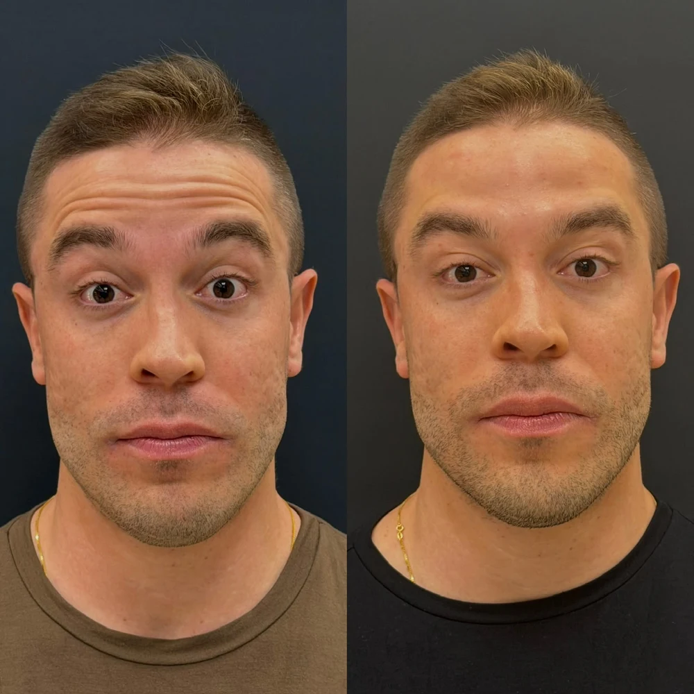 Caso Clínico Harmonização Facial Masculina - Antes e Depois na Clinic Allure