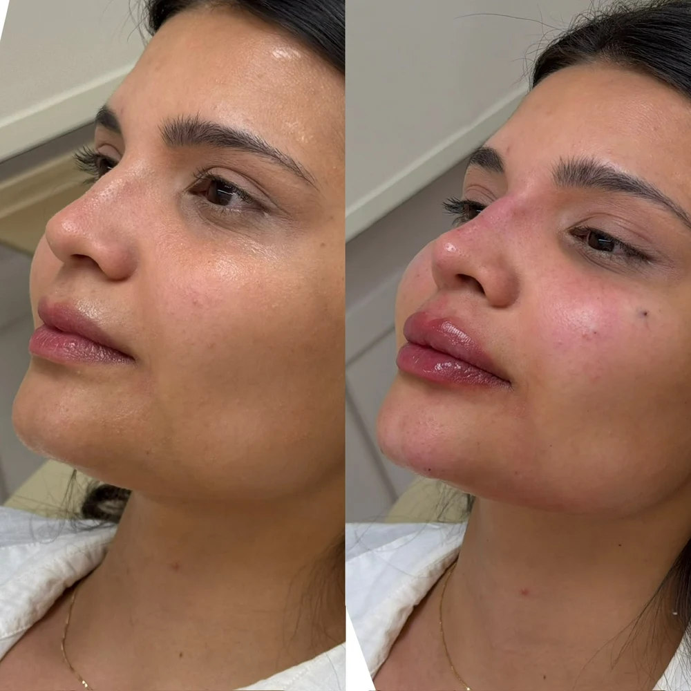 Caso Clínico Perfiloplastia e Rinomodelação - Antes e Depois na Clinic Allure