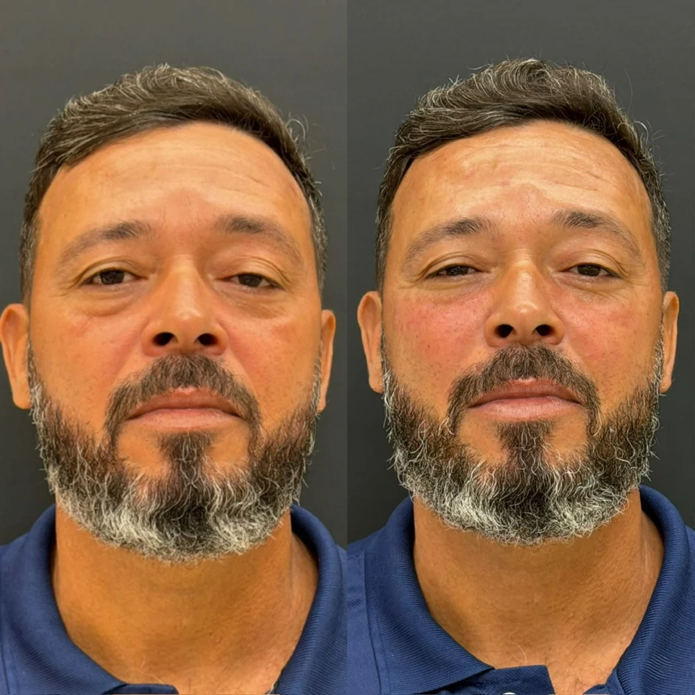 Caso Clínico Rejuvenescimento e Firmeza - Antes e Depois na Clinic Allure